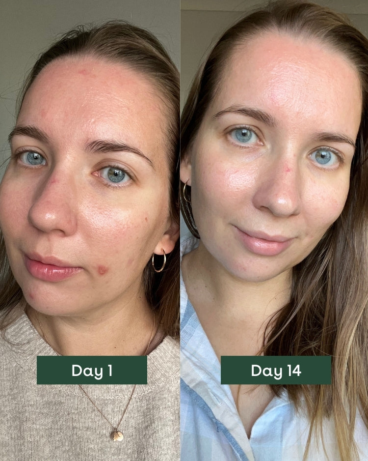 a woman with acne-prone skin showcasing a clear transformation from Day 1 to Day 14, highlighting fewer blemishes and improved skin texture, demonstrating the effectiveness of acne-prone, sensitive skin skincare products by biobod.