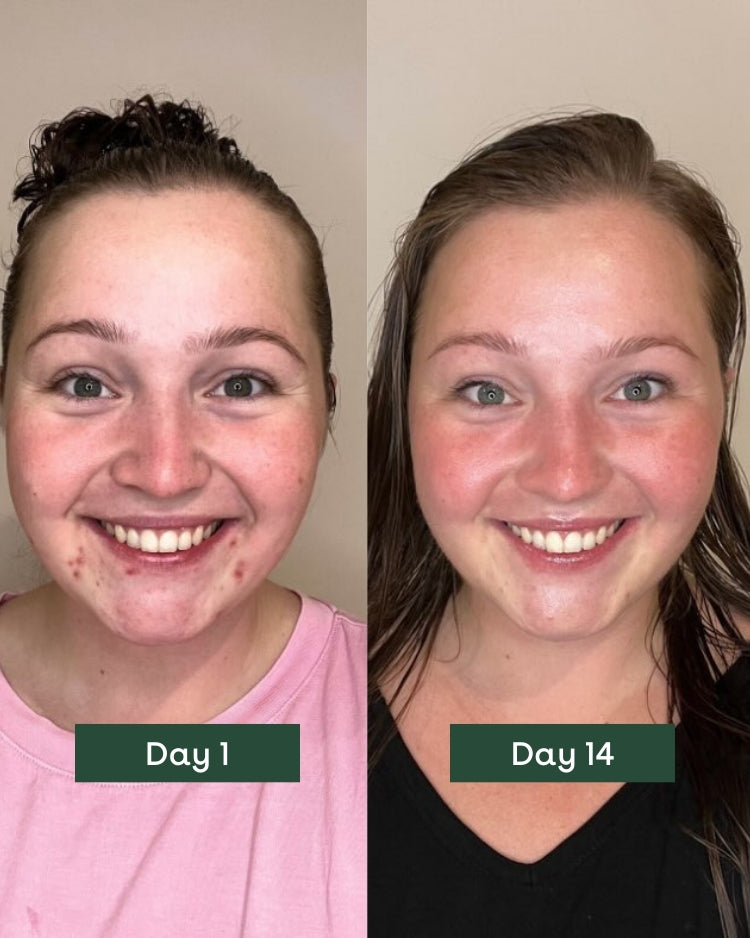  a woman with sensitive skin showing noticeable reduction in acne and breakouts from Day 1 to Day 14, demonstrating the effectiveness of skincare products for calming and improving sensitive skin conditions.