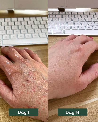 before and after in skin condition from Day 1 to Day 14, highlighting reduced redness, inflammation and dryness, showcasing the effectiveness of biobod&